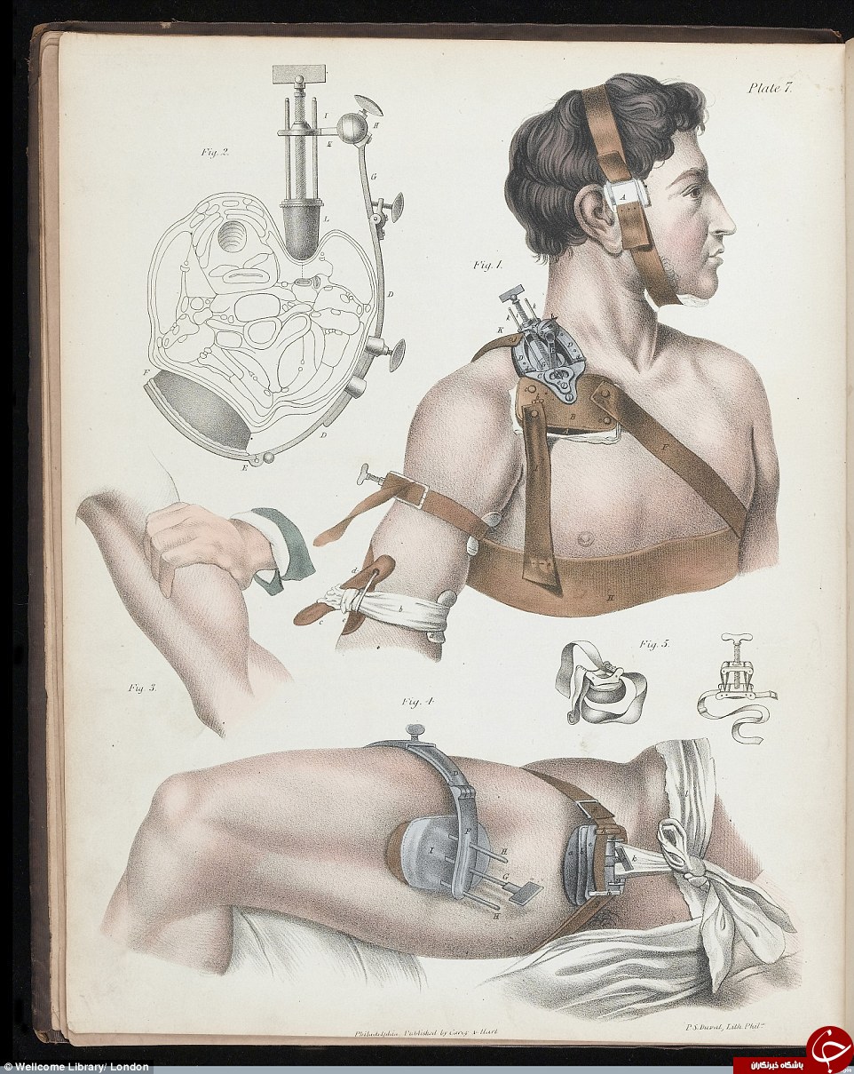تصاویری ترسناک از اعمال ابتدایی جراحی در قرون گذشته