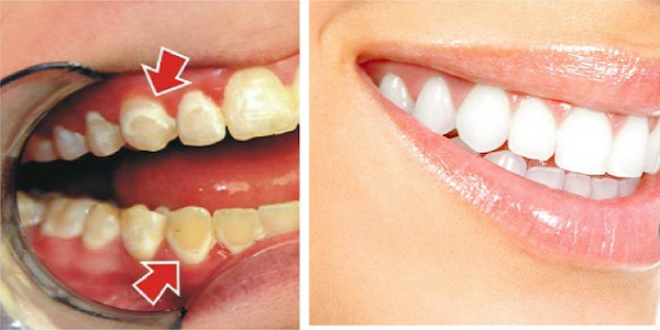 دندان های شما در عرض 5 دقیقه مانند مروارید می درخشد/ ترفندهایی که دندان هایتان رامثل مروارید سفید و درخشان می کند/ ترفندهای 5 دقیقه ای تا نوروز دندانهایتان را سفید و درخشان می کند/ ترفندهایی 5 دقیقه ای برای سفیدی و درخشندگی دندان ها تا نوروز/ ترفندهای جادویی برای سفیدی دندان ها تا نوروز/ سریعترین و ارزانترین راهکارها برای سفید دندان/ بدون نیاز به دندانپزشک تا نوروز دندان هایتان را سفید کنید