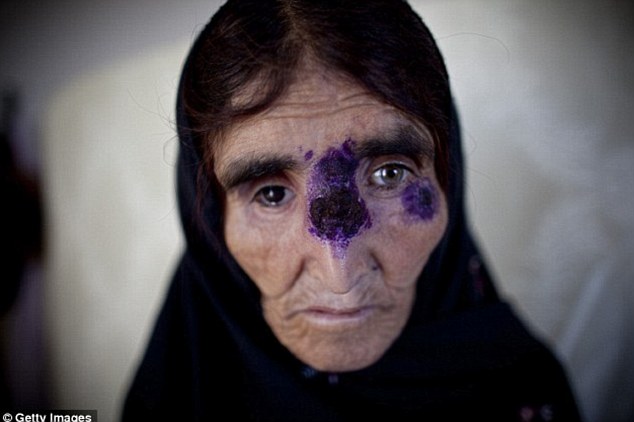 شیوع بیماری پوستی از مناطق تحت اشغال داعش به دیگر نقاط منطقه+ تصاویر