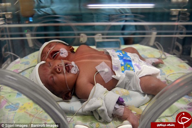 تولد نادر یک نوزاد 2 سر در اندونزی+تصاویر