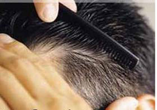 دلیل ریزش مو و روش‌های درمان آن‌ها