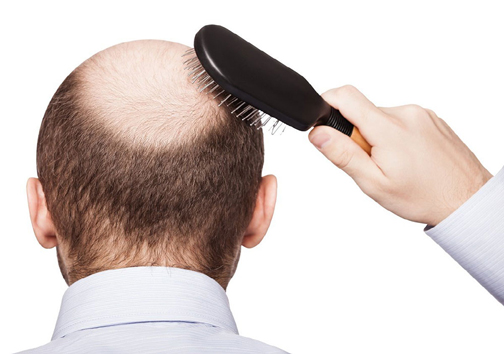 دلیل ریزش مو و روش‌های درمان آن‌ها