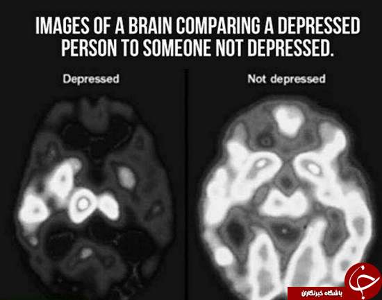 مغز در حالت افسردگی! +عکس