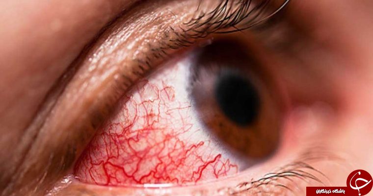 عواملی که سلامت چشم‌ها را به خطر می‌اندازد